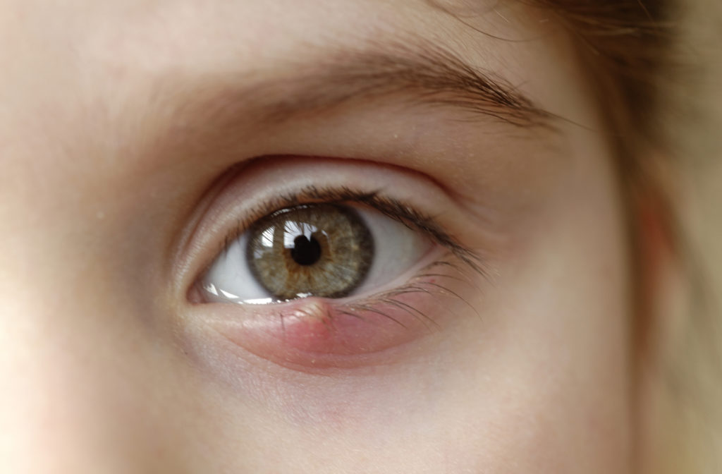 Close up of eye stye on young girls eye